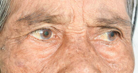 síndrome del ojo seco
